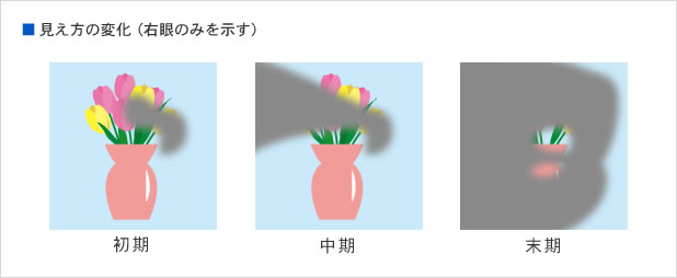 緑内障 見え方の変化